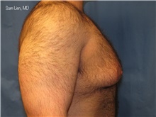Male Breast Reduction Before Photo by Samuel Lien, MD; Everett, WA - Case 44925