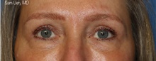 Eyelid Surgery After Photo by Samuel Lien, MD; Everett, WA - Case 45228
