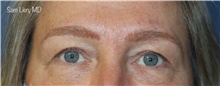 Eyelid Surgery Before Photo by Samuel Lien, MD; Everett, WA - Case 45228