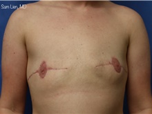 Gender Affirmation Surgery After Photo by Samuel Lien, MD; Everett, WA - Case 45229