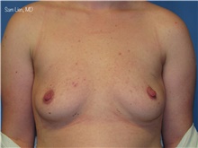 Gender Affirmation Surgery Before Photo by Samuel Lien, MD; Everett, WA - Case 45229