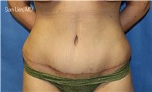 Tummy Tuck After Photo by Samuel Lien, MD; Everett, WA - Case 45231