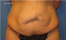 Tummy Tuck Before Photo by Samuel Lien, MD; Everett, WA - Case 45231
