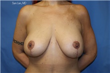 Breast Augmentation After Photo by Samuel Lien, MD; Everett, WA - Case 45232