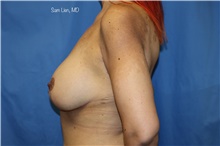 Breast Augmentation After Photo by Samuel Lien, MD; Everett, WA - Case 45232