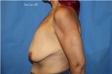 Breast Augmentation Before Photo by Samuel Lien, MD; Everett, WA - Case 45232