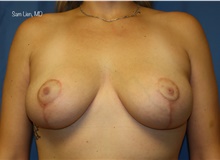 Breast Lift After Photo by Samuel Lien, MD; Everett, WA - Case 45354