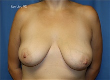 Breast Lift Before Photo by Samuel Lien, MD; Everett, WA - Case 45354