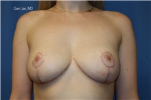 Breast Reduction After Photo by Samuel Lien, MD; Everett, WA - Case 45381