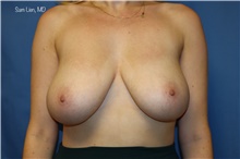 Breast Reduction Before Photo by Samuel Lien, MD; Everett, WA - Case 45381