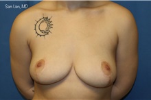 Breast Reduction After Photo by Samuel Lien, MD; Everett, WA - Case 45405