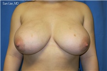 Breast Reduction Before Photo by Samuel Lien, MD; Everett, WA - Case 45405