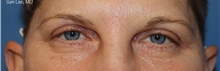 Eyelid Surgery After Photo by Samuel Lien, MD; Everett, WA - Case 45693