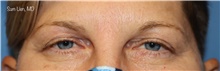Eyelid Surgery Before Photo by Samuel Lien, MD; Everett, WA - Case 45693