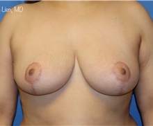 Breast Reduction After Photo by Samuel Lien, MD; Everett, WA - Case 45694
