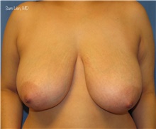 Breast Reduction Before Photo by Samuel Lien, MD; Everett, WA - Case 45694