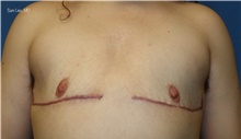 Gender Affirmation Surgery After Photo by Samuel Lien, MD; Everett, WA - Case 45695