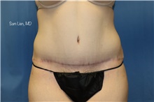 Tummy Tuck After Photo by Samuel Lien, MD; Everett, WA - Case 45868