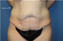 Tummy Tuck Before Photo by Samuel Lien, MD; Everett, WA - Case 45868