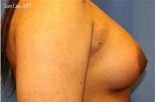Transfeminine Top Surgery After Photo by Samuel Lien, MD; Everett, WA - Case 46000