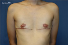 Gender Affirmation Surgery After Photo by Samuel Lien, MD; Everett, WA - Case 46303