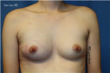 Gender Affirmation Surgery Before Photo by Samuel Lien, MD; Everett, WA - Case 46303