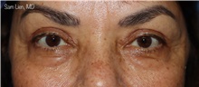 Eyelid Surgery After Photo by Samuel Lien, MD; Everett, WA - Case 46304