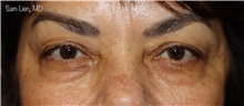 Eyelid Surgery Before Photo by Samuel Lien, MD; Everett, WA - Case 46304