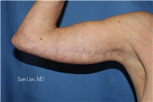 Arm Lift After Photo by Samuel Lien, MD; Everett, WA - Case 46521