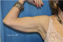 Arm Lift Before Photo by Samuel Lien, MD; Everett, WA - Case 46521