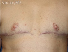 Gender Affirmation Surgery After Photo by Samuel Lien, MD; Everett, WA - Case 46690