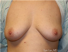 Gender Affirmation Surgery Before Photo by Samuel Lien, MD; Everett, WA - Case 46690