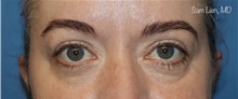 Eyelid Surgery After Photo by Samuel Lien, MD; Everett, WA - Case 47002