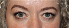 Eyelid Surgery Before Photo by Samuel Lien, MD; Everett, WA - Case 47002