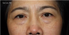 Eyelid Surgery Before Photo by Samuel Lien, MD; Everett, WA - Case 47481