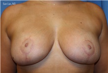 Breast Reduction After Photo by Samuel Lien, MD; Everett, WA - Case 47578