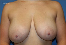 Breast Reduction Before Photo by Samuel Lien, MD; Everett, WA - Case 47578