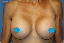 Breast Augmentation After Photo by Samuel Lien, MD; Everett, WA - Case 47926
