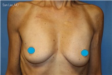 Breast Augmentation Before Photo by Samuel Lien, MD; Everett, WA - Case 47926