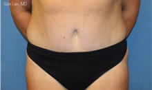 Tummy Tuck After Photo by Samuel Lien, MD; Everett, WA - Case 47927