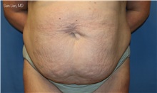 Tummy Tuck Before Photo by Samuel Lien, MD; Everett, WA - Case 47927