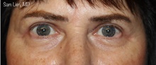 Eyelid Surgery After Photo by Samuel Lien, MD; Everett, WA - Case 48249