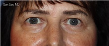 Eyelid Surgery Before Photo by Samuel Lien, MD; Everett, WA - Case 48249