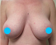 Breast Augmentation After Photo by Samuel Lien, MD; Everett, WA - Case 48354