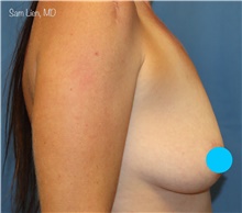 Breast Augmentation Before Photo by Samuel Lien, MD; Everett, WA - Case 48354