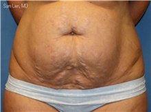 Tummy Tuck Before Photo by Samuel Lien, MD; Everett, WA - Case 48355