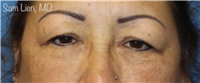 Eyelid Surgery Before Photo by Samuel Lien, MD; Everett, WA - Case 48419