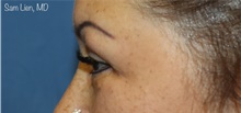 Eyelid Surgery After Photo by Samuel Lien, MD; Everett, WA - Case 48419