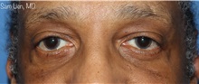 Eyelid Surgery After Photo by Samuel Lien, MD; Everett, WA - Case 48420