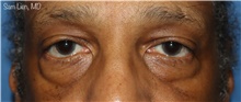 Eyelid Surgery Before Photo by Samuel Lien, MD; Everett, WA - Case 48420